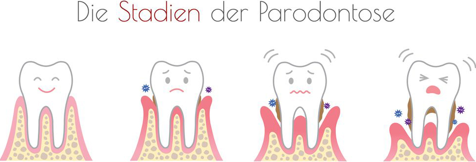 Parodontose Behandlung – Zahnarztpraxis Herget, Fulda